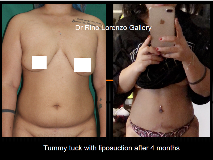 tummy tuck 1.png posted to IG.png